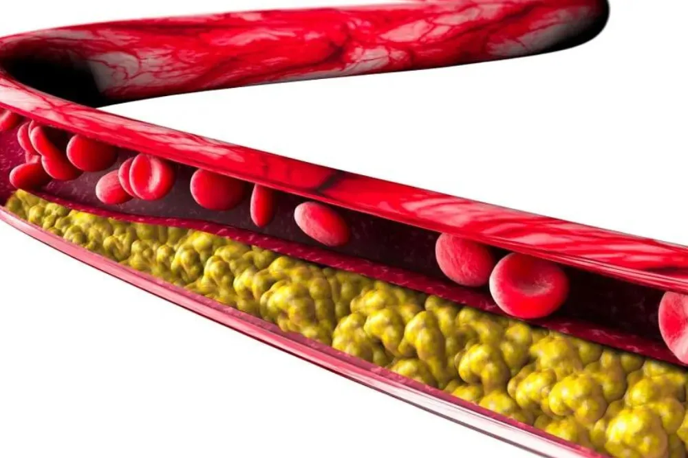 Po co badać poziom lipoproteiny(a)?